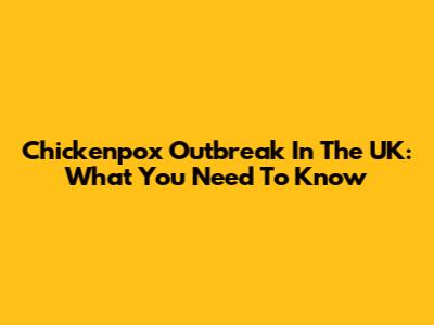 Chickenpox Outbreak In The UK: What You Need To Know