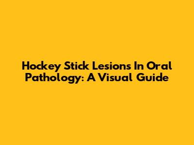 Hockey Stick Lesions In Oral Pathology: A Visual Guide